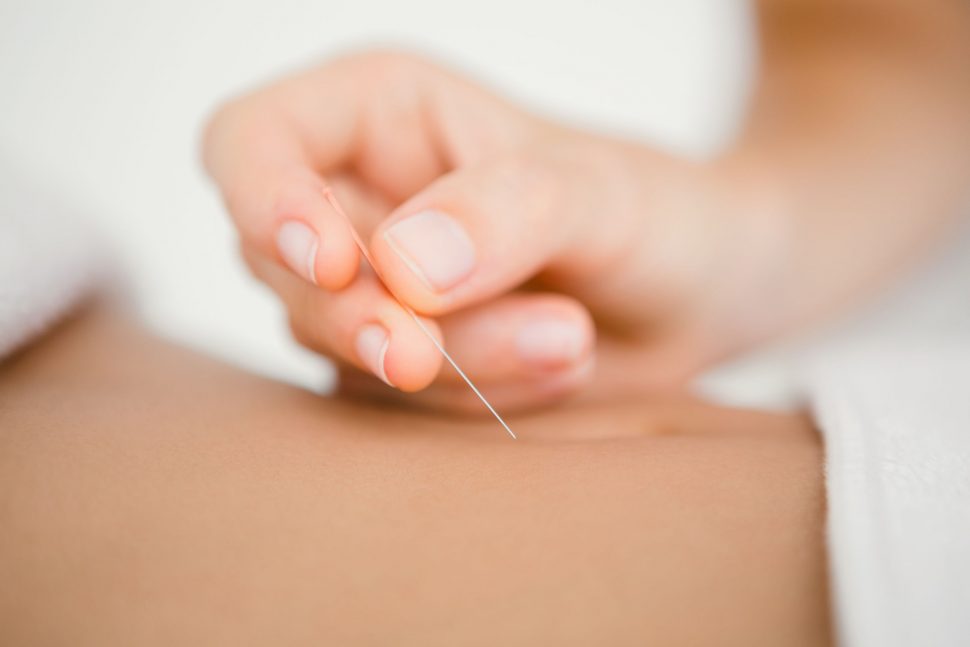 Acupuncture Near Me